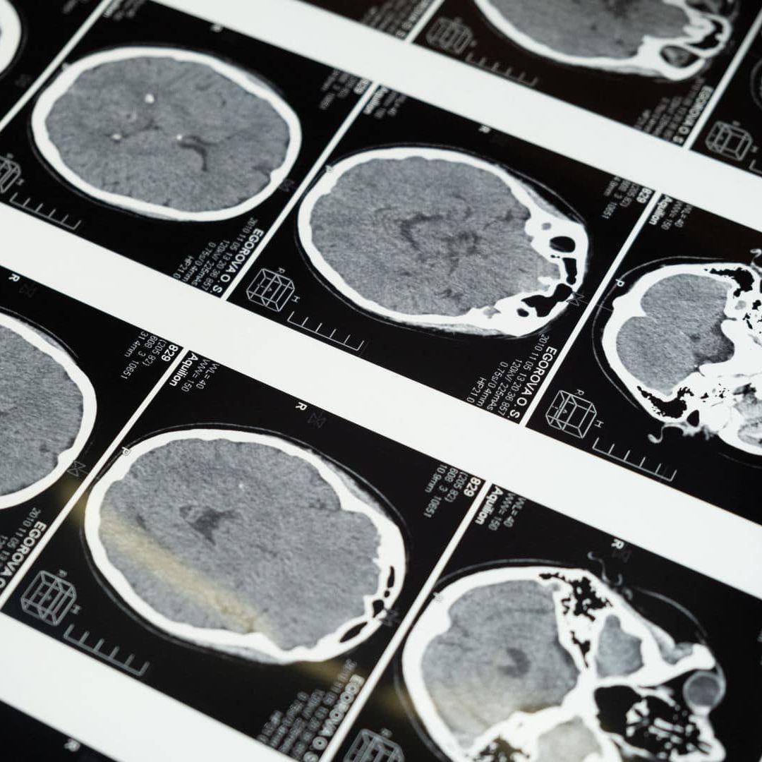 CBD and Concussions brain MRI